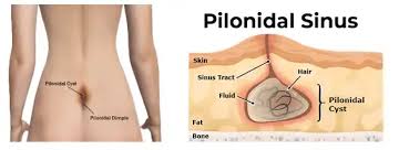 Pilonidal Sinus Diagram